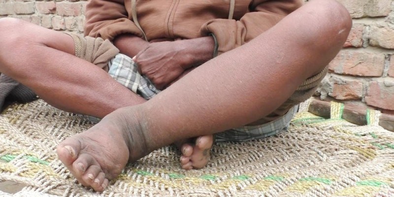 लुम्बिनीका तीन जिल्ला हात्तीपाइले रोगको उच्च जोखिममा