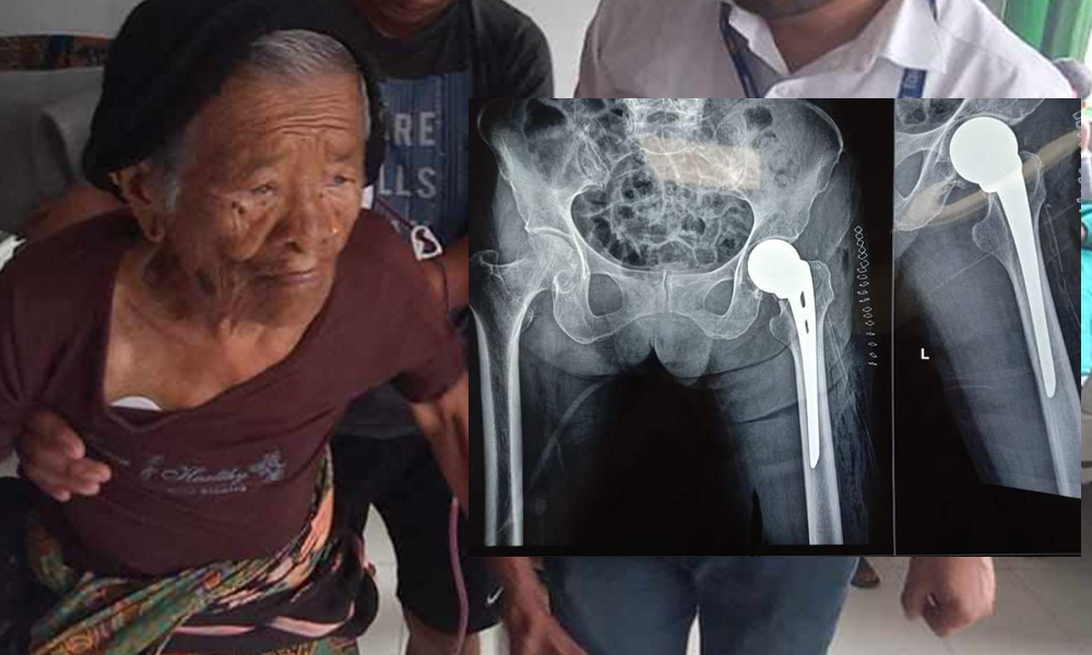 भरतपुर अस्पतालमा १०५ वर्षीया वृद्धाको हीप जोर्नी प्रत्यारोपण